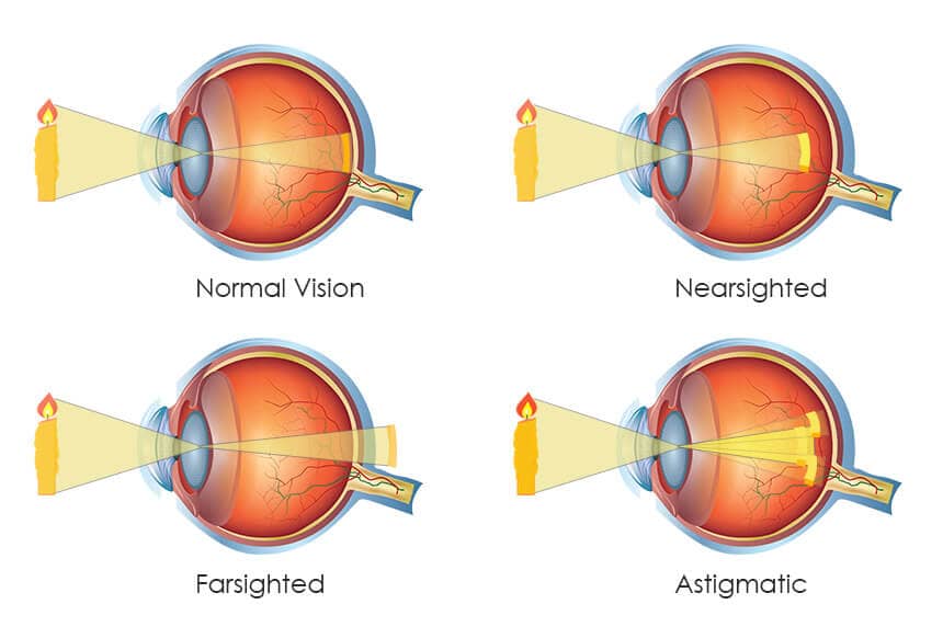 Mắt thường và các tật thông thường của mắt: cận, viễn, loạn