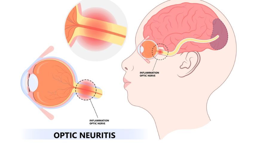 Viêm thần kinh thị giác 