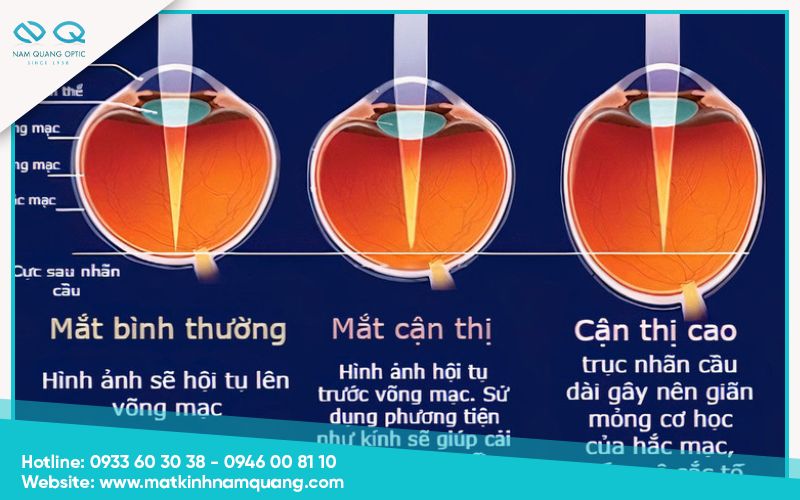 Cận Thị (2)