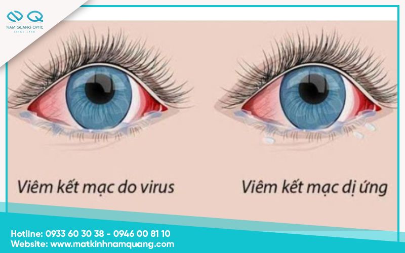 Viêm Kết Mạc Viêm Kết Mạc