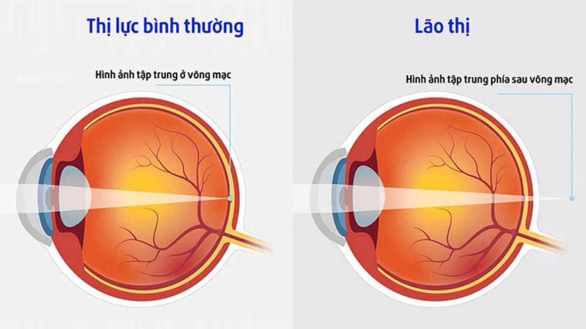 Cách thức hoạt động của kính lão