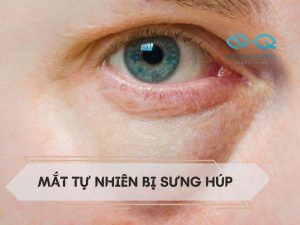 Mat-tu-nhien-bi-sung-hup