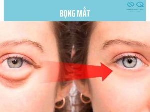 bọng mắt