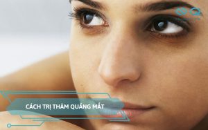 cách trị thâm quầng mắt