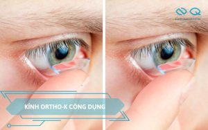 kính Ortho-K công dụng