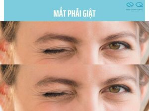 mắt phải giật