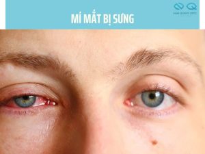 mí mắt bị sưng