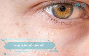 mụn trắng nổi ở mí mắt