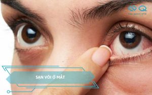 sạn vôi ở mắt
