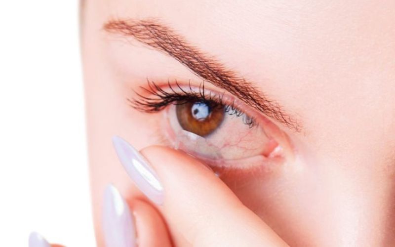 mắt bị sưng húp do kính áp tròng