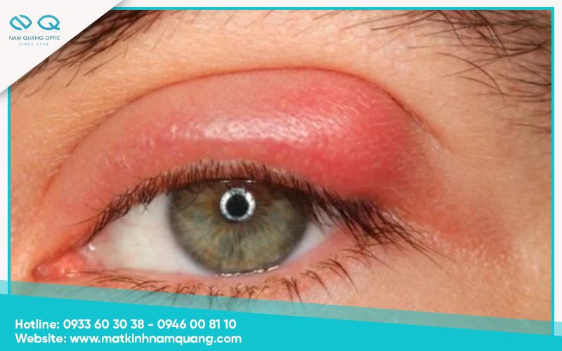 Hiện tượng sưng mí mắt là bị gì?