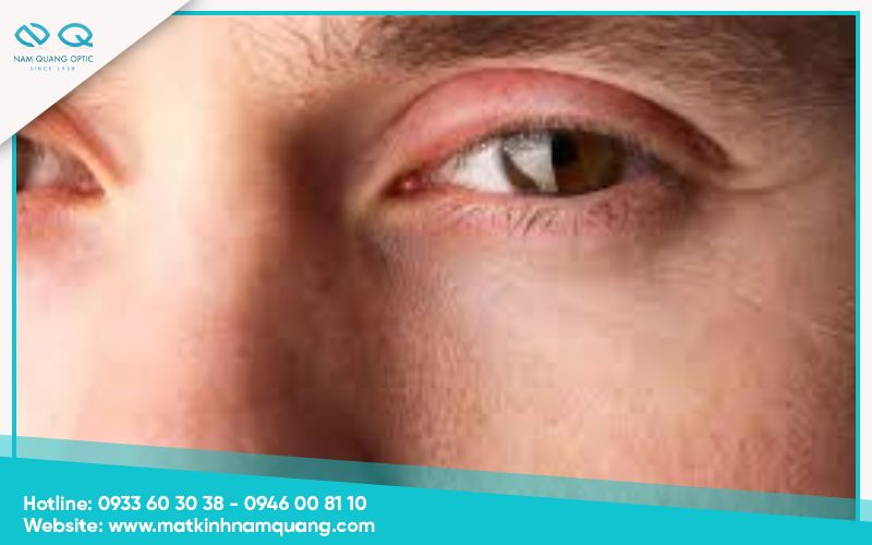 Tại sao mí mắt bị sưng? 5 nguyên nhân phổ biến nhất