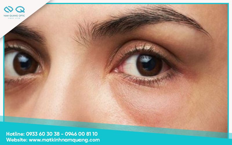 Nhận biết dấu hiệu mắt bị sưng mí trên và mí dưới