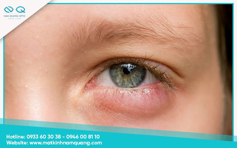 Biện pháp phòng ngừa tình trạng mí mắt bị sưng tái phát