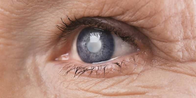 Mắt bị đục thủy tinh thể do hấp thụ tia UV và ánh sáng xanh sau nhiều năm