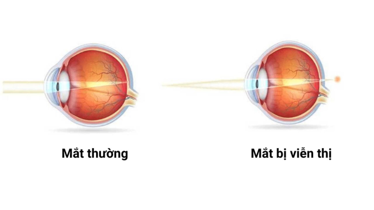 Ánh sáng không được khúc xạ đúng cách để tập trung trên võng mạc