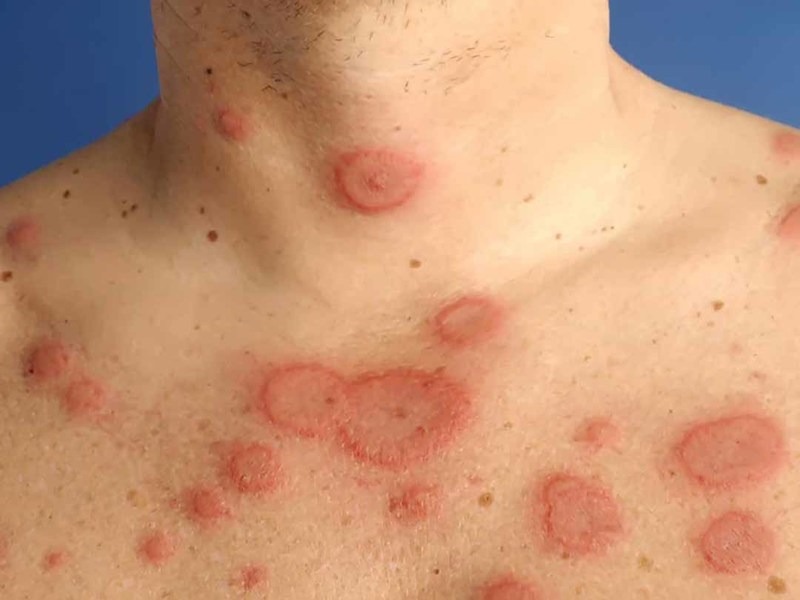 Bệnh tự miễn: viêm khớp dạng thấp, lupus ban đỏ hệ thống