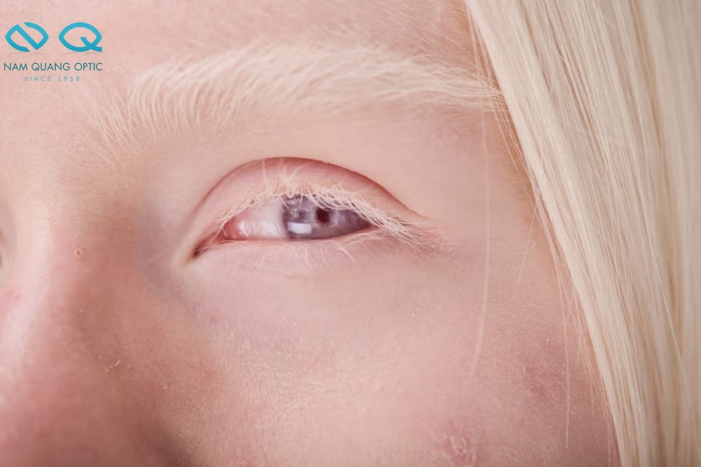 Mắt của người Waardenburg Syndrome có thể phản xạ ánh sáng tạo nên màu mắt tím nhẹ Mắt Màu Tím