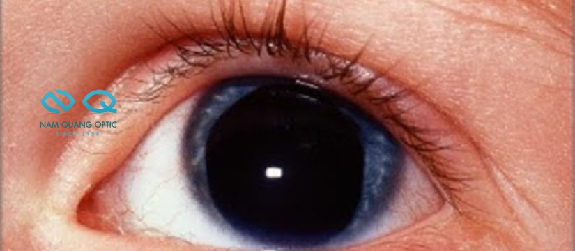 Aniridia (vô mống mắt)