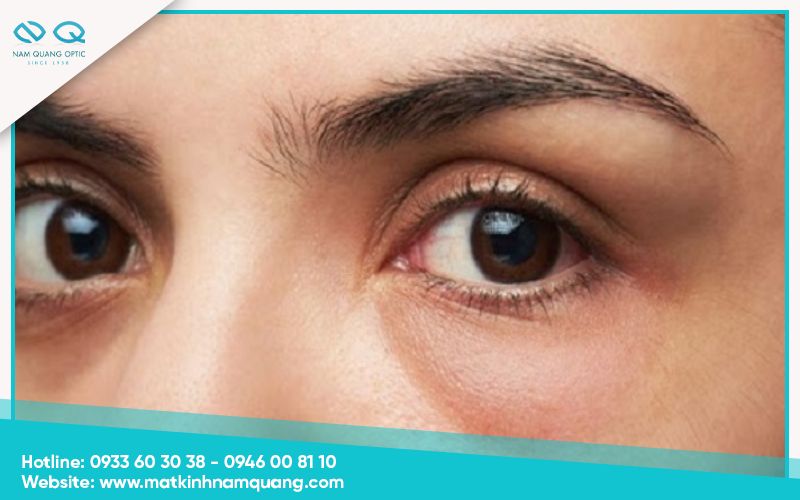 Dáng mắt hốc sâu Dáng mắt hốc sâu