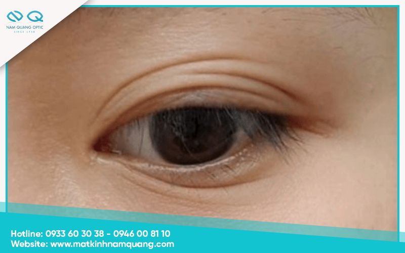 Mắt nhiều nếp mí Mắt nhiều nếp mí