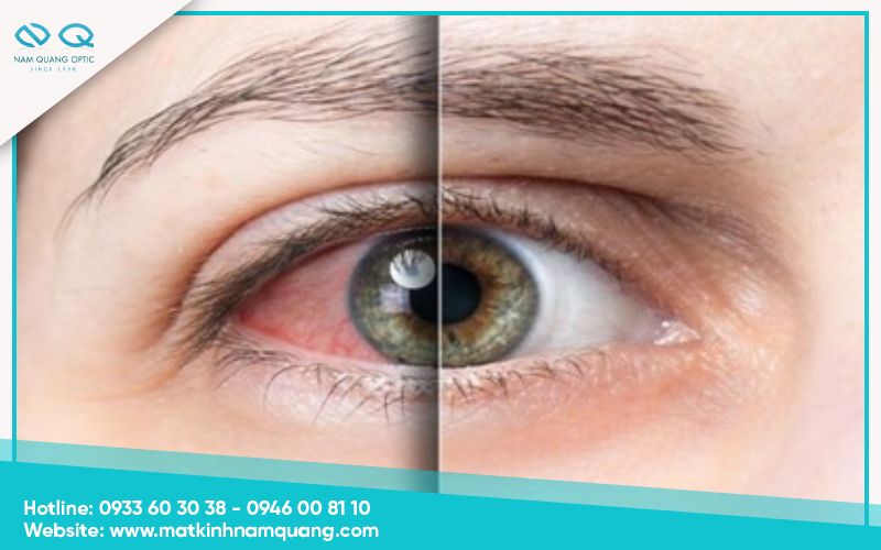 Cach-massage-mat-tai-nha-2 Thực trạng mỏi và khô mắt trong cuộc sống hiện đại