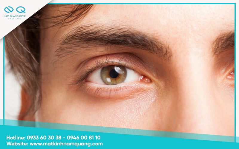 Một số lưu ý cần tránh khi áp dụng cách trị đau mắt khi hàn điện