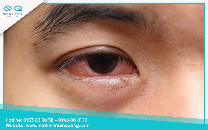 Cách trị đau mắt đỏ nhanh hết