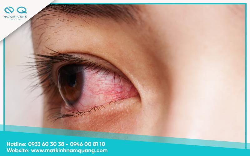 Cach-tri-dau-mat-han-hieu-qua-11 Lưu ý khi chữa đau mắt hàn