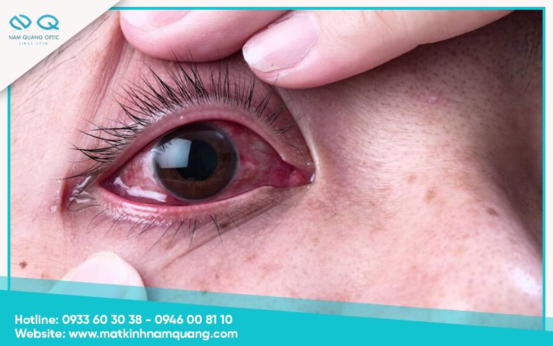 Cach-tri-dau-mat-han-hieu-qua-2 Khái niệm và dấu hiệu của đau mắt hàn