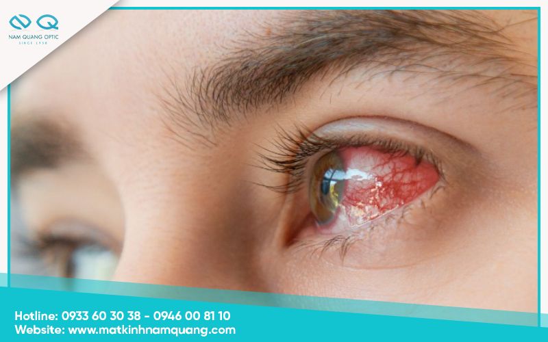 Bụi bẩn bám vào kính áp tròng