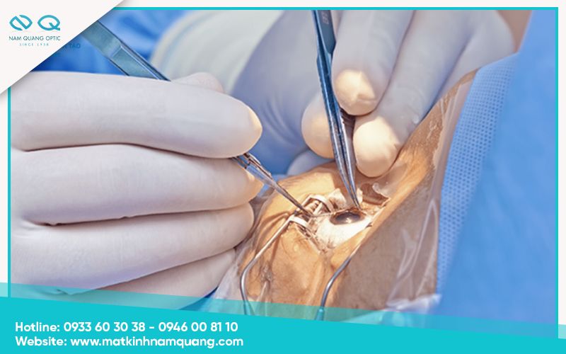 Phẫu thuật Phaco