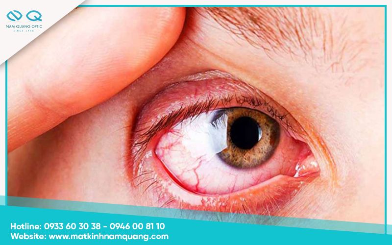 Tác hại khi đeo lens đi bơi