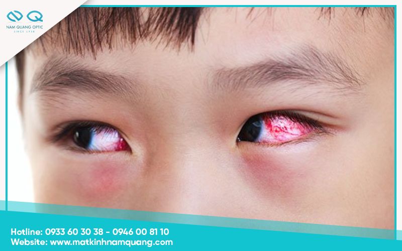 Những thực phẩm nên và không nên ăn khi đau mắt