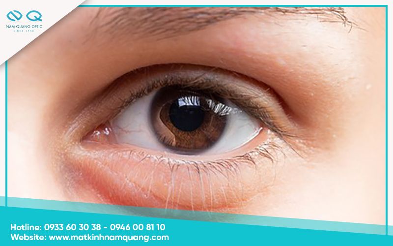 Chuom-nong-mat-co-tac-dung-gi-18 Mắt sưng nhẹ do thiếu ngủ hoặc stress