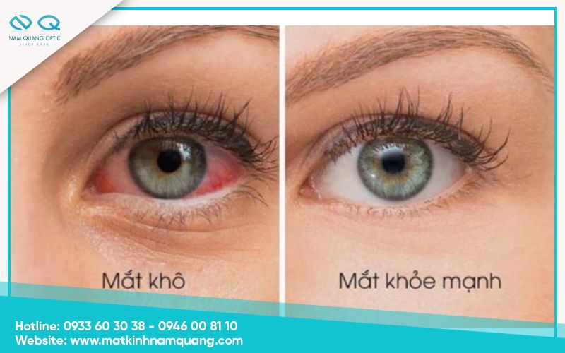 Chuom-nong-mat-co-tac-dung-gi-4 Giảm khô mắt