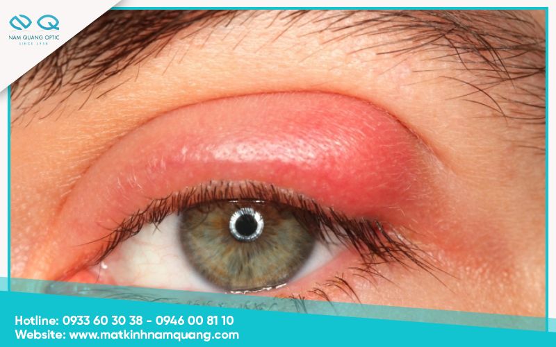 Chuom-nong-mat-co-tac-dung-gi-6 Hỗ trợ giảm viêm bờ mi