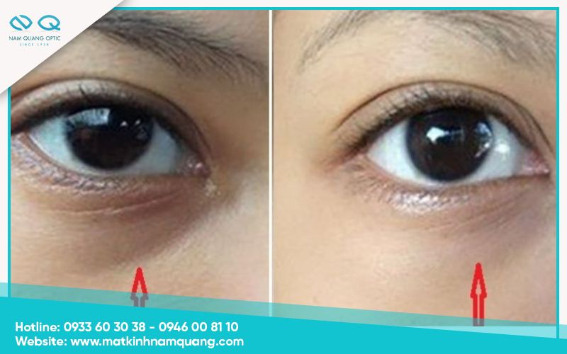 Chuom-nong-mat-co-tac-dung-gi-7 Giảm quầng thâm mắt