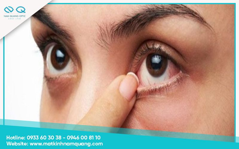 Mắt bị cộm nhưng không có bụi là bị gì?