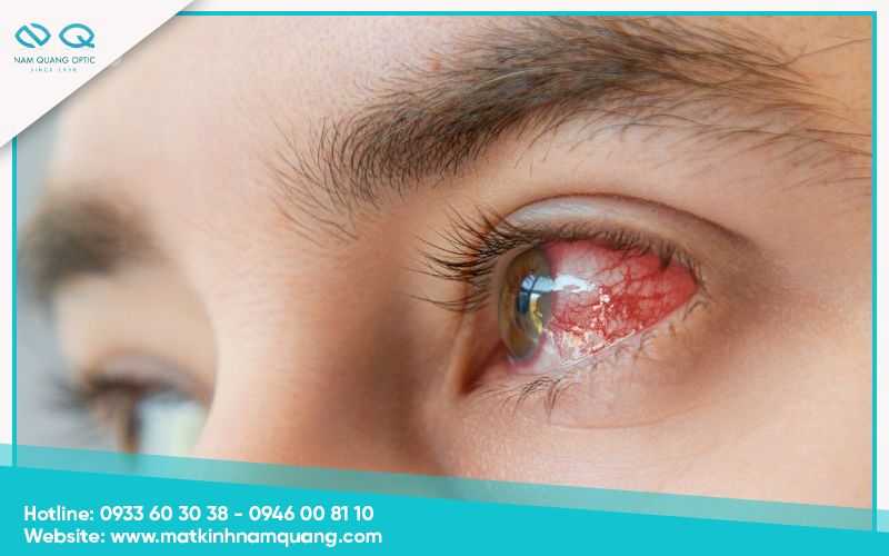 Mắt bị cộm có những biểu hiện gì?