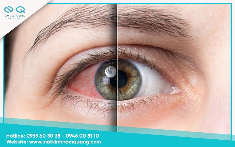 Cộm mắt do khô mắt