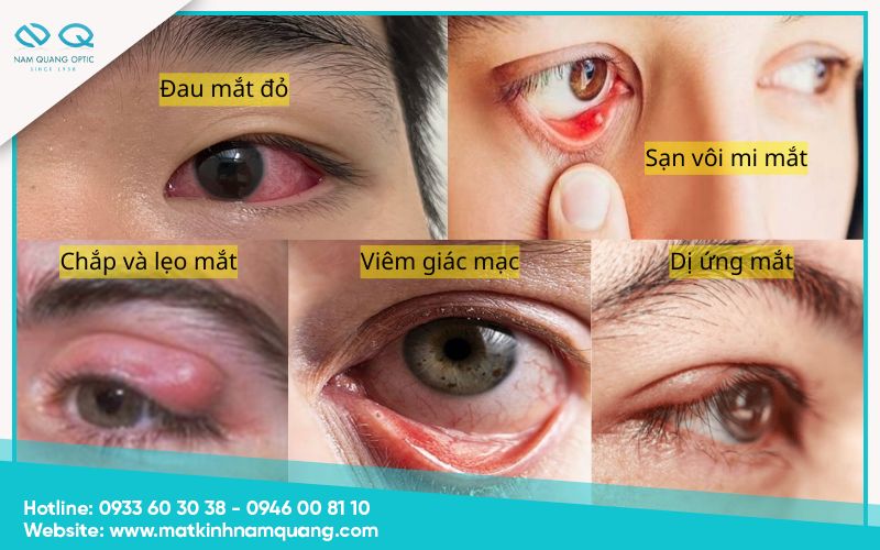 Các bệnh lý gây ra cộm mắt