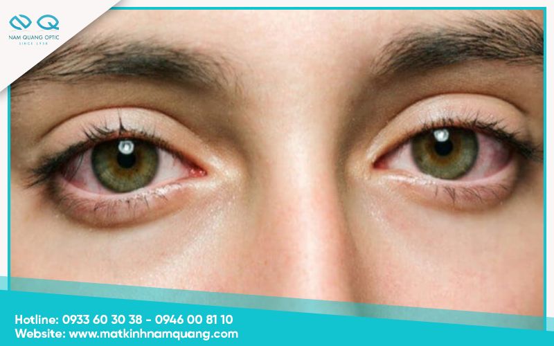 Mắt bị dại là gì? Nguyên nhân và cách khắc phục