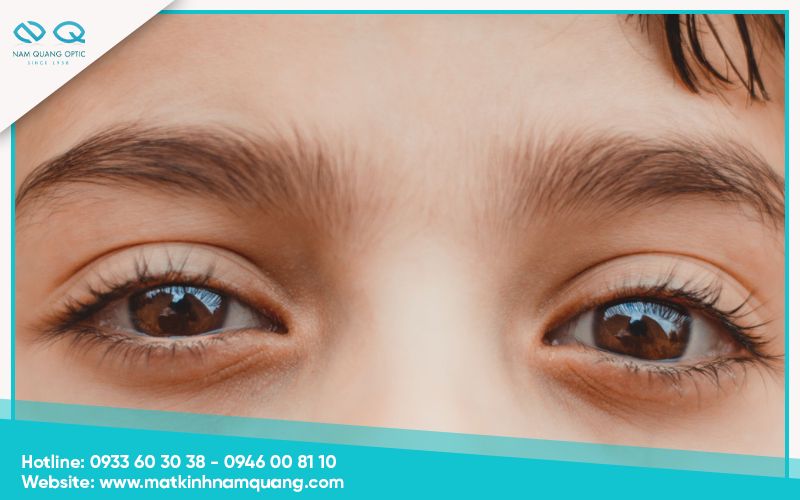 Những hiểu lầm về mắt bị dại