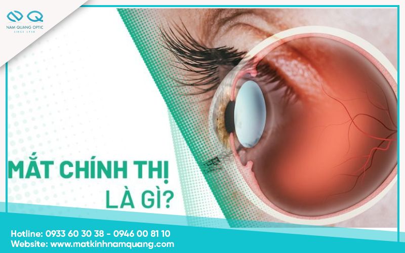 Mắt chính thị là gì? Dấu hiệu nhận biết và cách phân biệt mắt chính thị