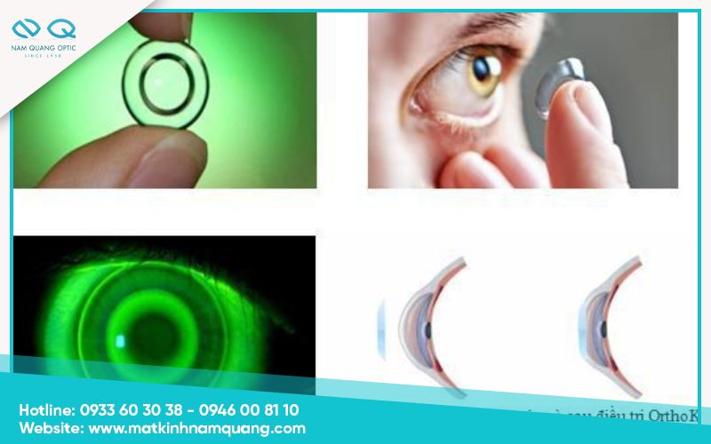 Chỉnh hình giác mạc ban đêm bằng kính Ortho-K