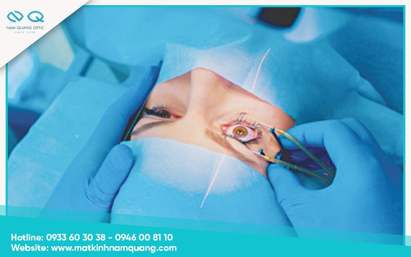 Phẫu thuật khúc xạ bằng laser