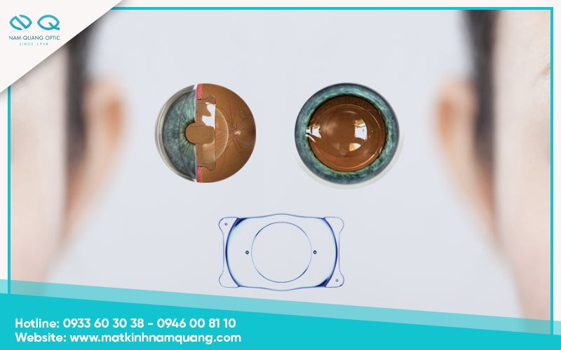 Phẫu thuật đặt kính nội nhãn Phakic