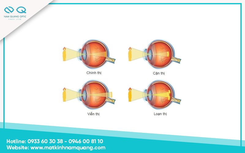 Đặc điểm của mắt chính thị