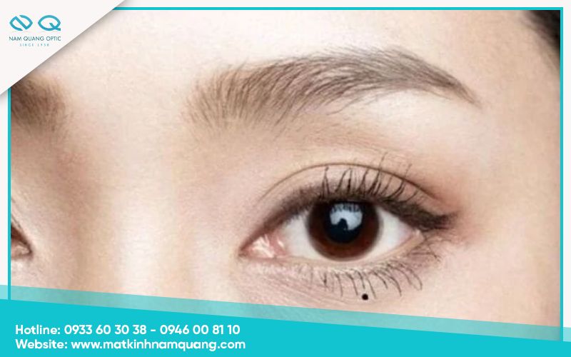 Nốt ruồi dưới mắt phải